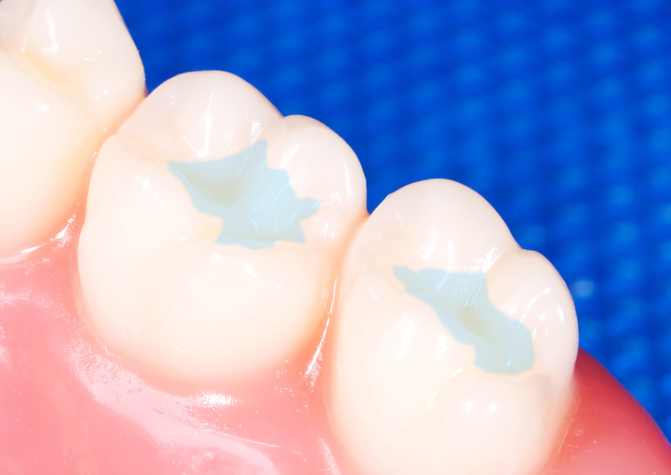 むし歯を予防するための「フッ素塗布」と「シーラント」