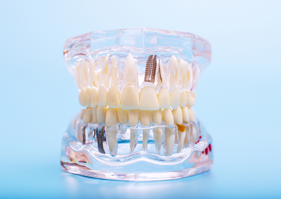 インプラント