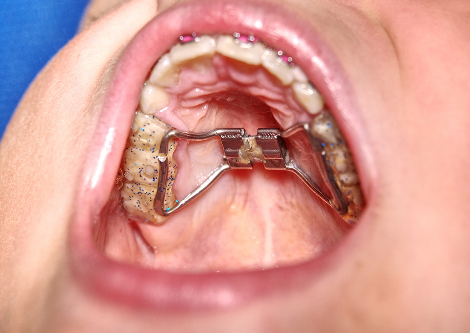 固定式拡大装置を使った治療法